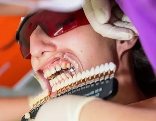 روش انجام دادن لمینت دندان چگونه است